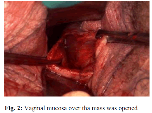 Short communication: A rare case of vaginal dermoid cyst: A case report and  review of literature